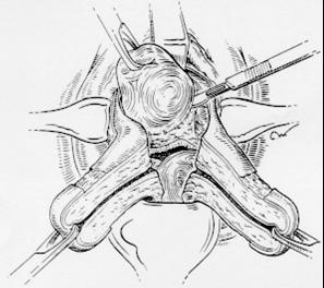 TÉCNICA CIRÚRGICA Exteriorização do útero Incisão em cunha ( V ): remoção de porções