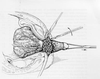 TÉCNICA CIRÚRGICA Exteriorização do útero Enucleação (coring): incisão