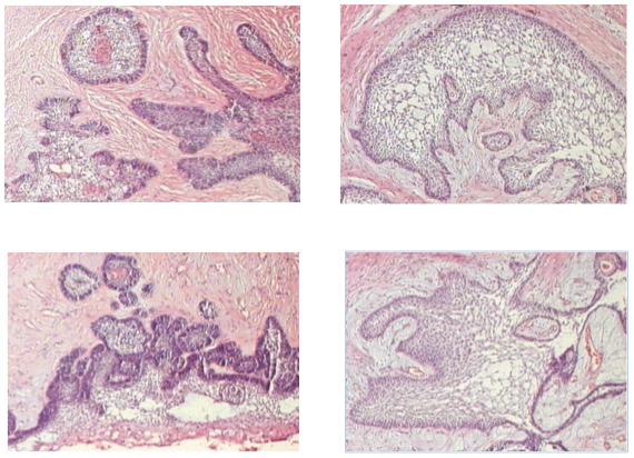 Fig. 4- Fotomicrografias em HE exibindo ameloblastoma