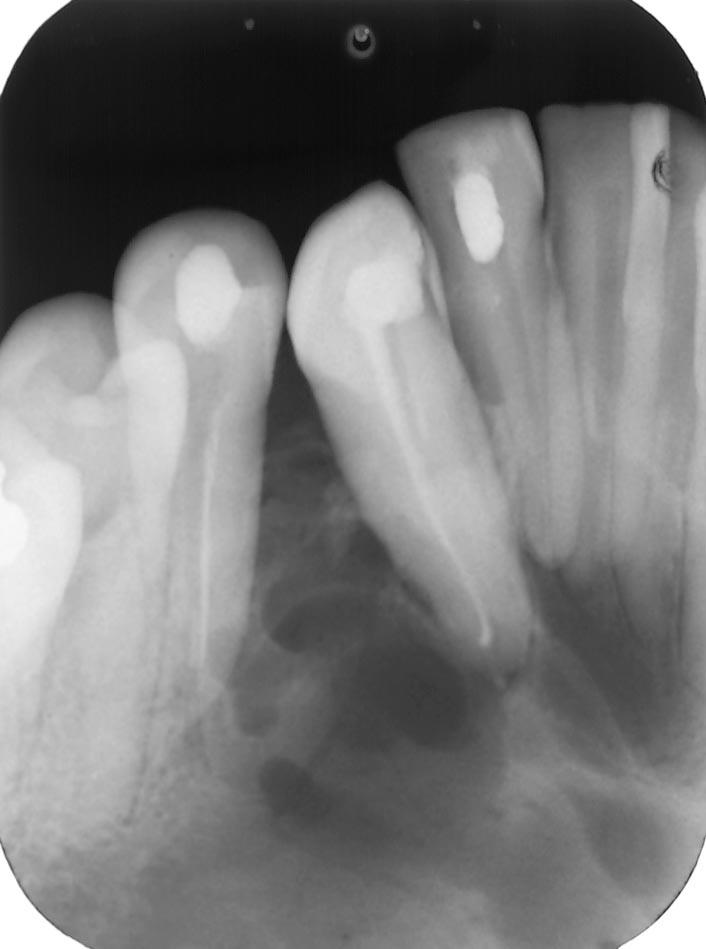 Fig. 3 A, B, C Radiografias periapicais evidenciando detalhes da lesão radiolúcida