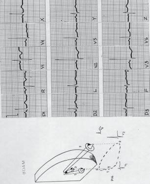 importante (Figura 14) Figura 13 Bloqueio divisional esquerdo posterior Embaixo, processo de ativação ventricular, com os três vetores; o 3 orientado para baixo e para a direita e para trás, compondo