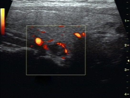 Revisão da Literatura 13 Figura 2 Ultrassonografia com Doppler de amplitude (Power Doppler) evidenciando fluxo exclusivamente na periferia de um nódulo sólido da tireoide.