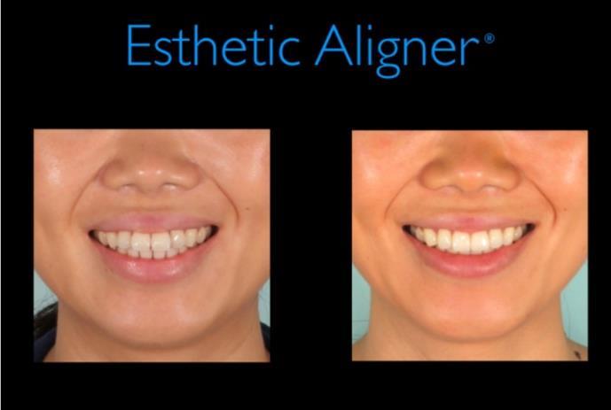 Clínicos Tratados Com Esthetic Aligner CASO