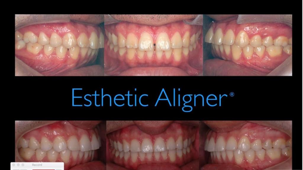 Aligner