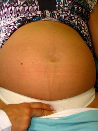 Nas primigestas, após a queda do ventre, decorrente da fixação e/ou insinuação da apresentação fetal, ocorre uma redução da altura uterina, atingindo