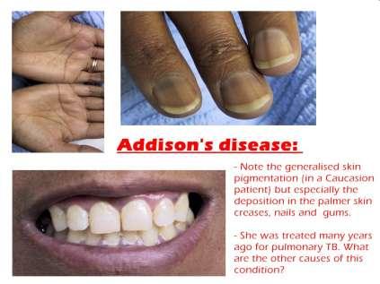 Doença de Addison Quadro clínico: Fraqueza, fadiga Anorexia, perda de peso náuseas, vômitos,
