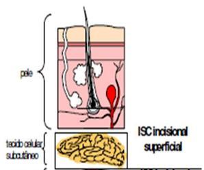 Critérios para definição de ISC Diagnóstico de infecção