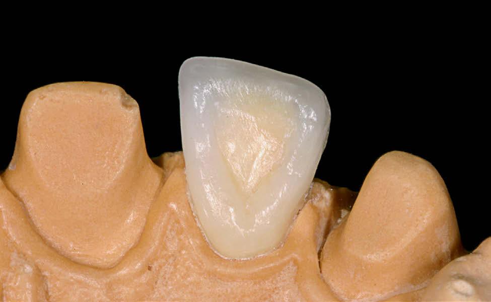 marginal. Figura 25 - plicação de cera translúcida sobre todo o dente.