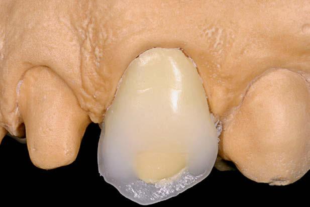 Figura 31 - plicação de cera amarela clara para reproduzir os mamelões dentinários.