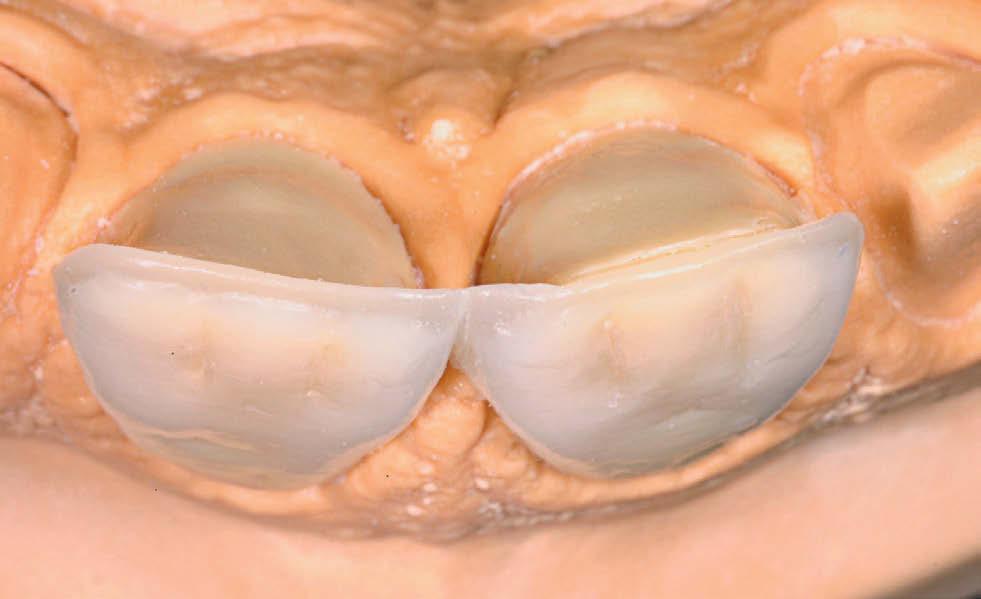 dentina nesta área (vista vestibular).