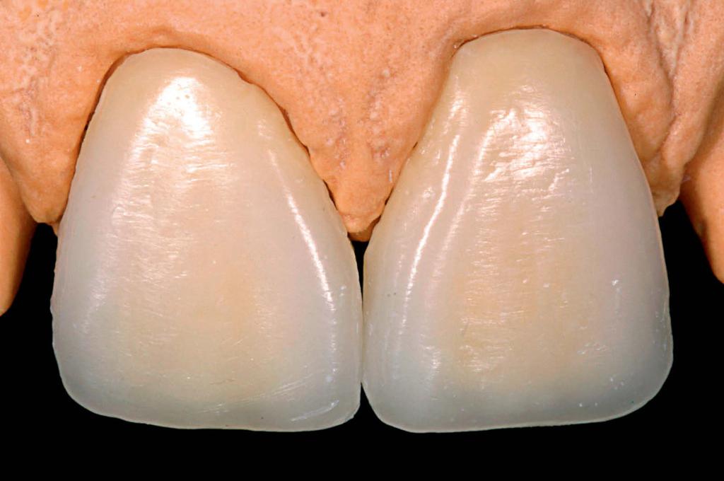 Essas áreas devem ser marcadamente mais volumosas em comparação à região central da face vestibular.