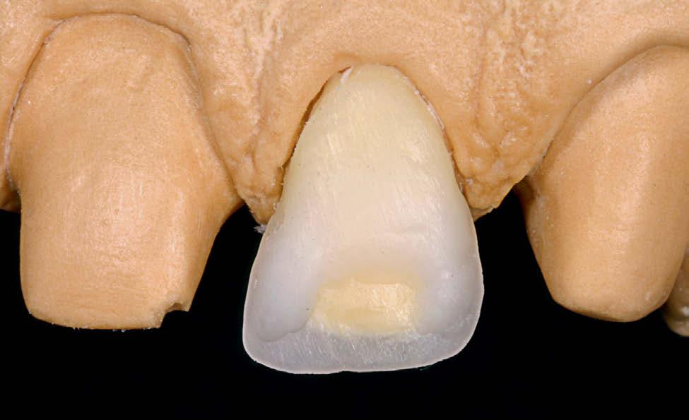 Técnica de enceramento incremental: anteriores superiores Figura 20 - plicação de cera branca no terço