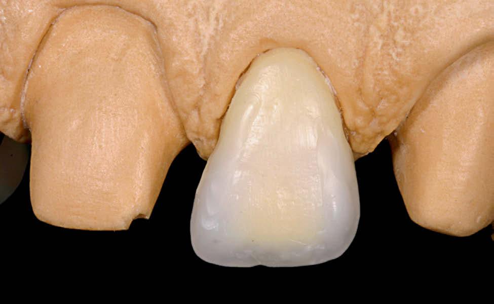 Figura 21 - plicação de cera amarela clara para reproduzir os mamelões dentinários.