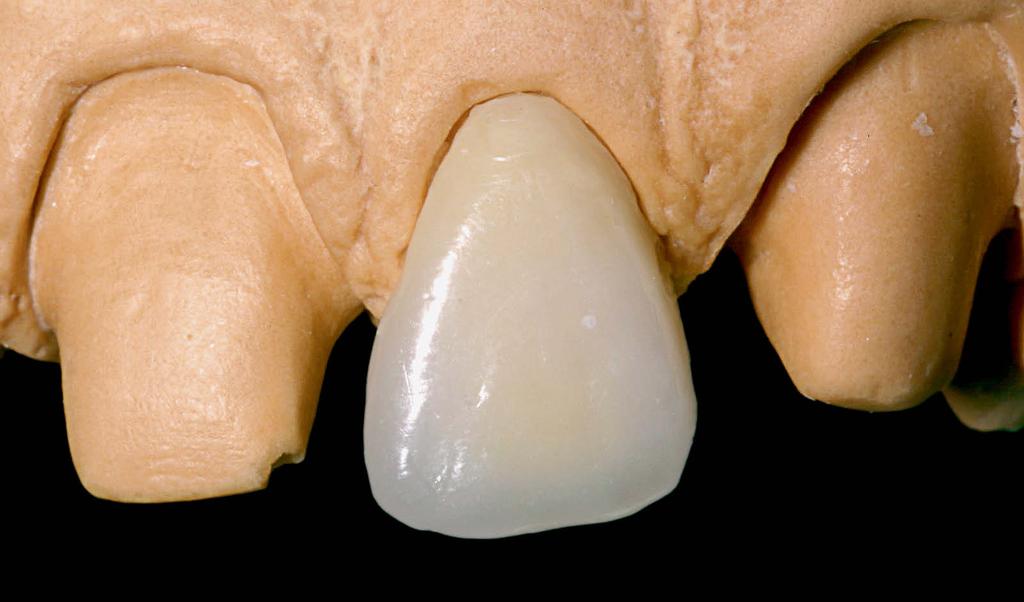 região incisal.