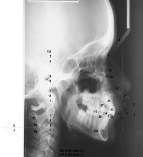 3. RESULTADOS Utilizando as medidas lineares, angulares, na cefalometria (Figura 10), no programa Dolphin Imaging em telerradiografias laterais, durante um ano de uso do Ativador.