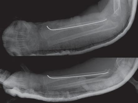 Luís Pinheiro et al Figura 2. Rx pós-operatório de fratura desviada da tacícula radial (Judet tipo III) numa criança de 6 anos de idade tratada por técnica de Metaizeau.