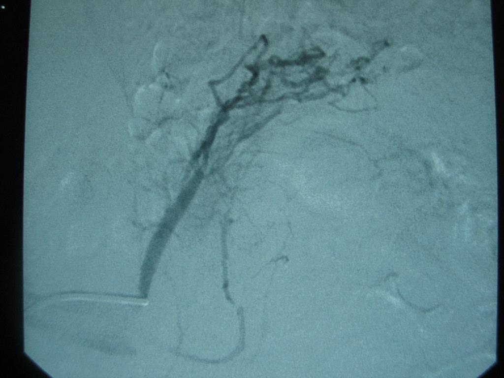 Adrenal Esq Aldosterona= = 758 ng/dl Veia esquerda