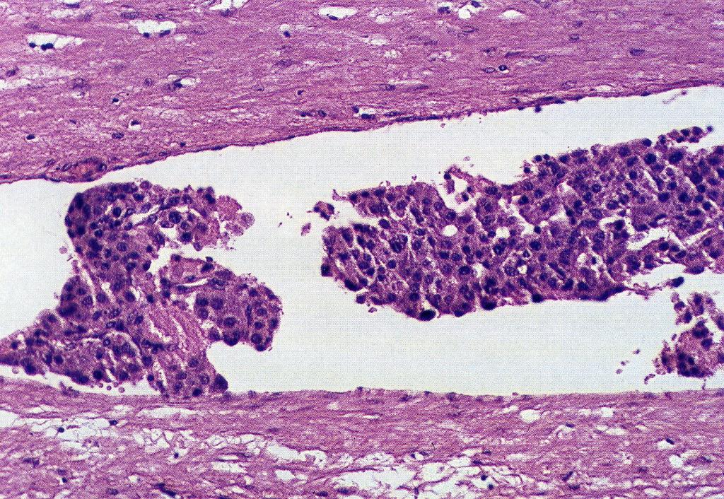 Carcinoma X Adenoma