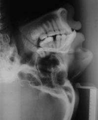 Material e métodos 87 Figura 10 Telerradiografias em norma lateral tomadas logo após a remoção do aparelho Pendulum e no final do alinhamento/nivelamento do arco dentário