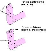Clinicamente, o sinal de Babinski é produzido passando-se cuidadosamente na parte lateral do pé um objeto de ponta arredondada e estendendo o estímulo discretamente para o aspecto medial através da