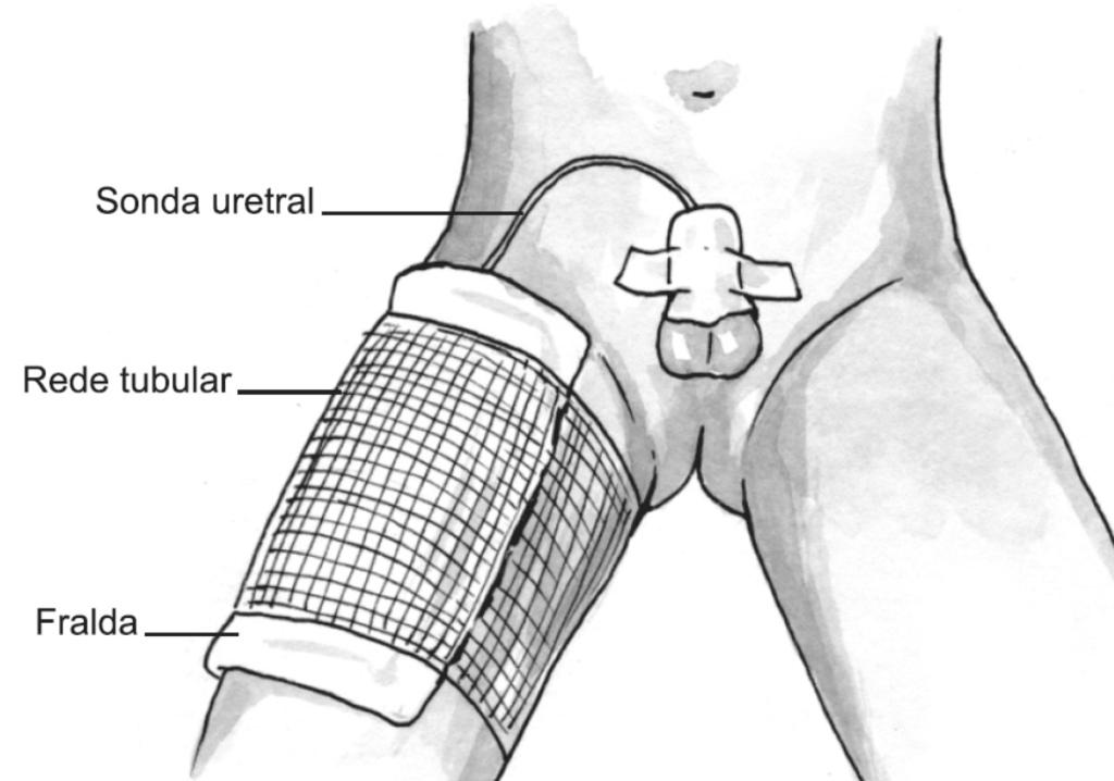 Sonda uretral É a sonda que fica na uretra após a cirurgia para permitir a saída de urina. Ela é flexível e presa por um ponto na ponta do pênis.