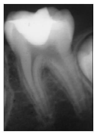 Imagem 4- Imagem ilustrativa de radiografia de 17 meses pós-tratamento. O paciente está assintomático. (Lee, D. S. D. J., Bogen, G.