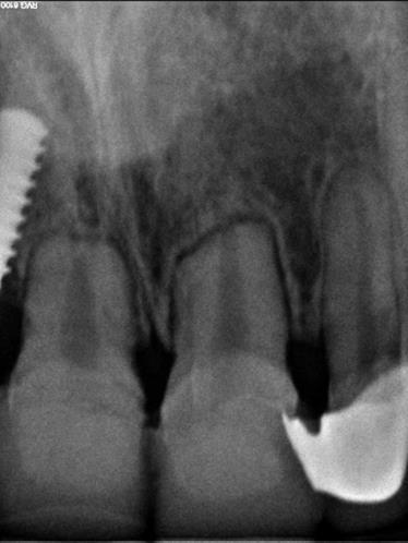 2.3 Caso 2 Paciente sexo feminino 18 anos, história de trauma, diagnostico de necrose pulpar, instrumentação, ProTaper Next MAILLEFER Dentsply, 50/05 a calibragem apical revelou calibre