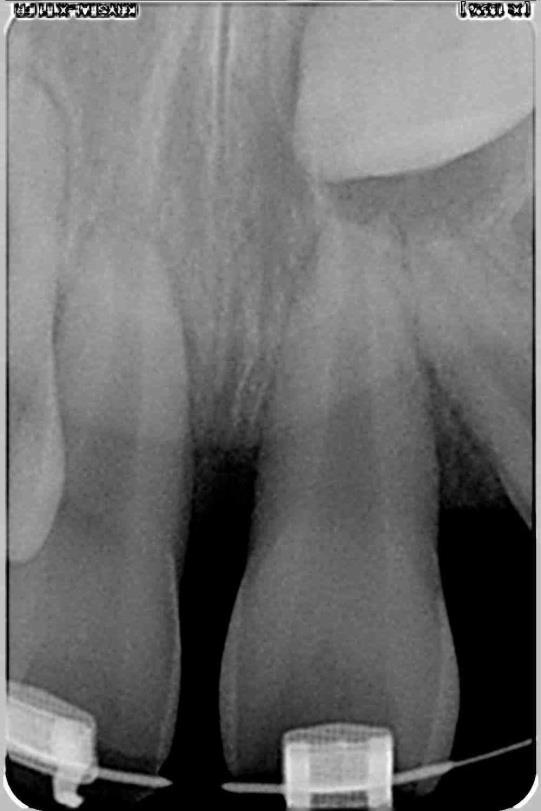 2.4 Caso 3 Reabsorção por forças ortodonticas.