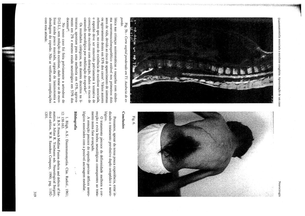 Diastematomielia associada a escoliase congénita. Apresentac;:ao de um caso Fig. 5b.- Corte sagital ponderado em TI. Ausencia de esporao.
