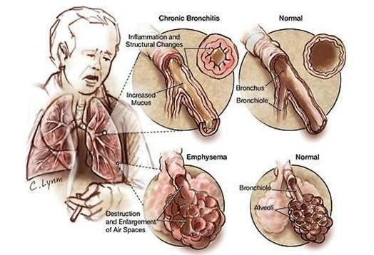 Enfisema