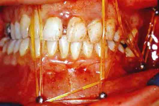 Nos casos de extrações dentárias, incisões intrabucais incluíram a gengiva inserida ao redor do dente envolvido.