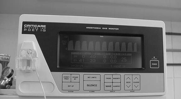 Reinalação Exaustão da cal sodada Hipertermia maligna ( súbito) Ausência de CO 2 expirado ü Intubação esofágica ü Apnéia Redução gradativa Hiperventilação Hipoperfusão pulmonar Perda pelo circuito /