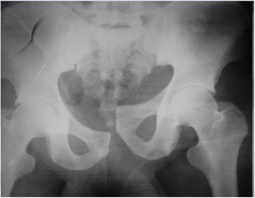 Lavado peritoneal diagnóstico (LPD) Avaliação ultrassonográfica direcionada para o trauma (FAST) Tomografia