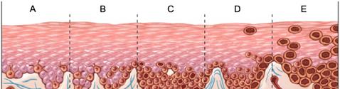 Melanoma