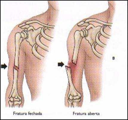 Fraturas CLASSIFICAÇÃO Significa osso quebrado Fechada: pele intacta sem ferimento próximo Aberta: pele rompida próximo ao local da fratura TIPOS DE FRATURA Fratura exposta Fratura simples Existe