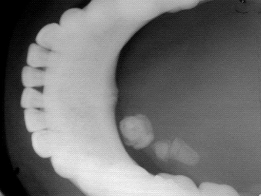 Os sialolitos podem ser observados radiograficamente, sendo a grande maioria visível de forma radiopaca, e uma simples radiografia oclusal podem identificar o cálculo, quando localizado no