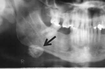 Já as radiografias panorâmicas, laterais oblíquas de mandíbula, póstero-anteriores de crânio, além das tangenciais para exames dos tecidos moles da bochecha são indicadas para a pesquisa de