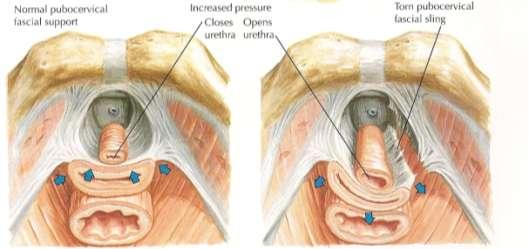 IUE Hipermobilidade do colo vesical Pressão abdominal elevada não se transmite de