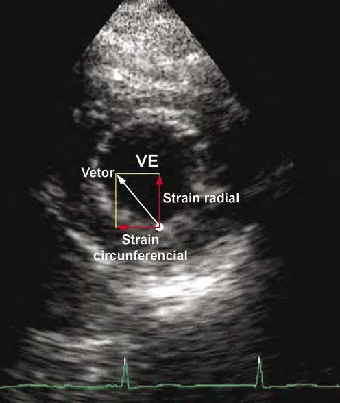Rev bras ecocardiogr imagem cardiovasc. 2010; 23(3):46-54. ao ápex, acompanhando a diminuição do strain radial 19.