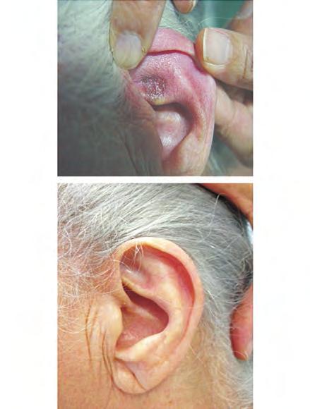 A A B Fig 1 - CBC superficial localizado no pavilhão auricular esquerdo. A - Antes da TFD. B - Follow-up de 7 anos após a realização de TFD.