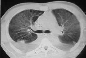 Manobras de Recrutamento Alveolar na SARA: o Aeração de unidades alveolares colapsadas por meio de pressurização sustentada das vias aéreas o Homogeneização do parênquima pulmonar PRÉ-MR PEEP 5cmH 2