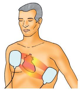 A desfibrilação precoce é o único tratamento para parada cardiorrespiratória em fibrilação ventricular/taquicardia ventricular sem pulso, pode ser realizada com um equipamento manual (somente