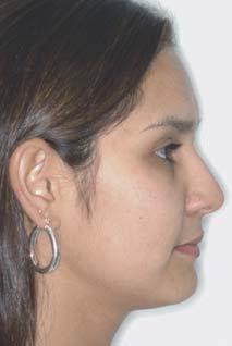 A FIGURA 2 - A aparência de deficiência mandibular, em relação à posição do lábio superior, define o Padrão II.