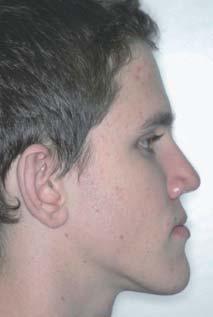 Os Padrões Face Longa e Face Curta são discrepâncias evidenciadas no sentido vertical, e correspondem à extrapolação da variação de normalidade da face na vista frontal (Fig. 4).