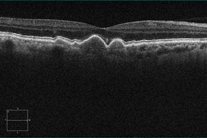 abundantes B, C e G Retinalmap 3D,