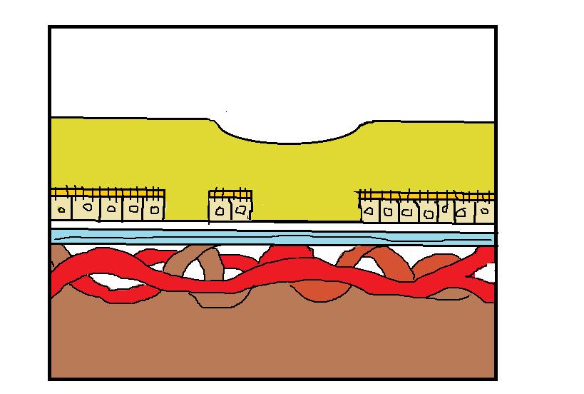 Fig. 15 Esquema da DMI atrófica FSES D NGIOGRFI FLUORESCEÍNIC: rterio-venosa: Evidencia da