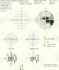 K L Fig. 22 DMI atrófica, B, E, F e I Retinografias DMI atrófica.