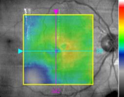 Esta banda hiperreflectiva separase do EPR por uma área menos reflectiva. Edema intraretiniano suprajacente.