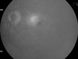C D E Fig. 28 NVSR oculta Retinografia Lesão amarelo-esbranquiçada na área macular. B a D Hiperfluorescência que aumenta de intensidade. Boirdos mal definidos.