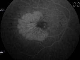 C D E Fig. 41 DEP seroso. Retinografia Bolha alaranjada na área macular.